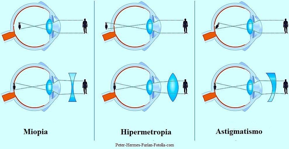 Resultado de imagem para miopia e hipermetropia